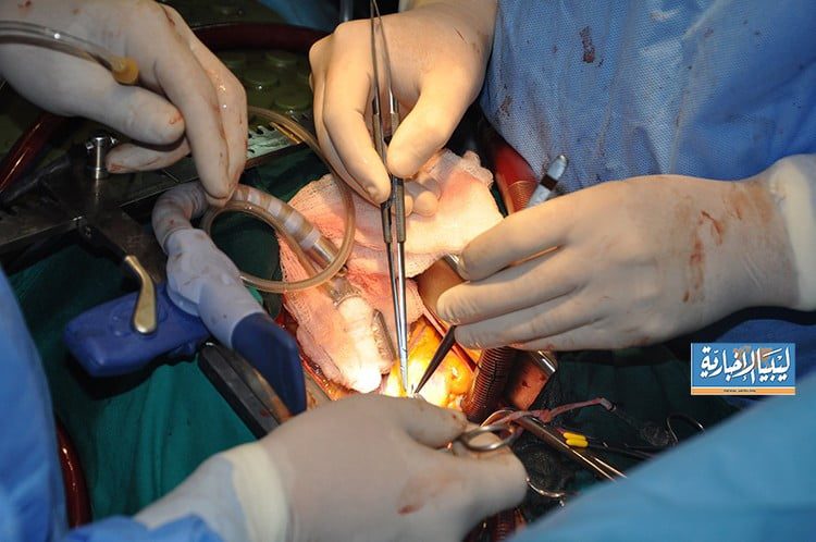 المستشفى الجامعي طرابلس نجاح عملية استئصال ورم على قلب مريضة تصل قيمتها 100 ألف دينار في مصحات القطاع الخاص 2 1 admin