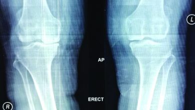 الجامعي طرابلس يستأنف زراعة مفصل الركبة ويدعو المرضى مراجعة عيادات العظام الخارجية