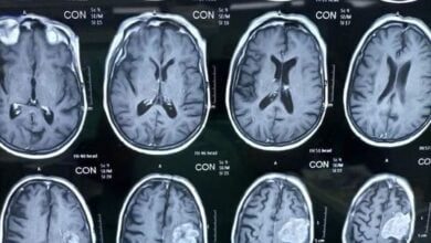 استئصال كتلة ورمية من رأس مريض عمره 73 عاما